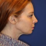 CoolSculpting Elite Before & After Patient #14213