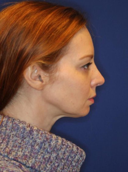 CoolSculpting Elite Before & After Patient #14213