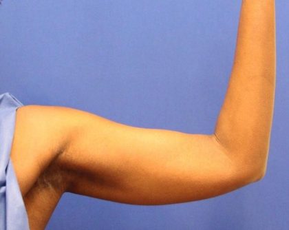 CoolSculpting Elite Before & After Patient #14215