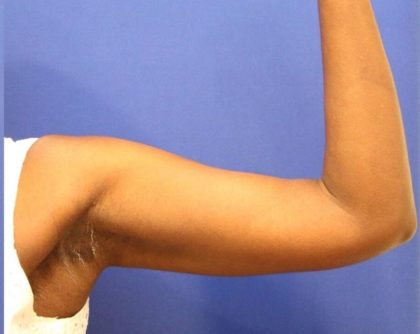CoolSculpting Elite Before & After Patient #14215