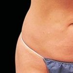 CoolSculpting Elite Before & After Patient #14216