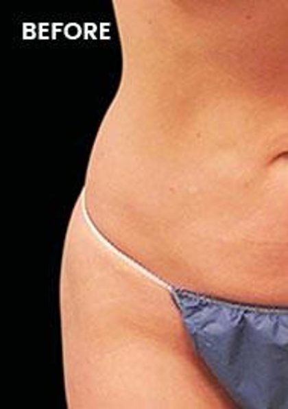 CoolSculpting Elite Before & After Patient #14216