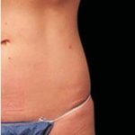 CoolSculpting Elite Before & After Patient #14216