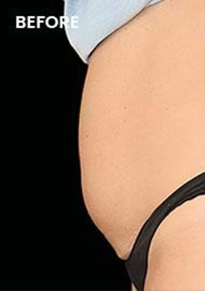 CoolSculpting Elite Before & After Patient #14217