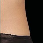 CoolSculpting Elite Before & After Patient #14217