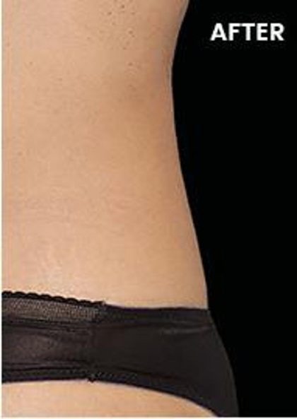 CoolSculpting Elite Before & After Patient #14217