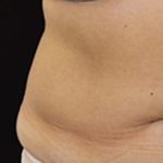 CoolSculpting Elite Before & After Patient #14218