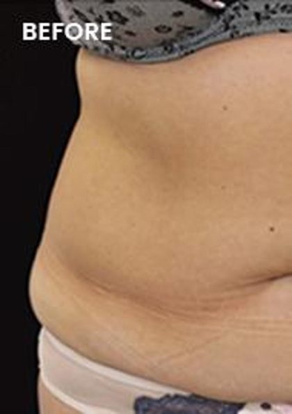 CoolSculpting Elite Before & After Patient #14218