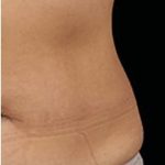 CoolSculpting Elite Before & After Patient #14218