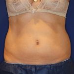 CoolSculpting Elite Before & After Patient #14219