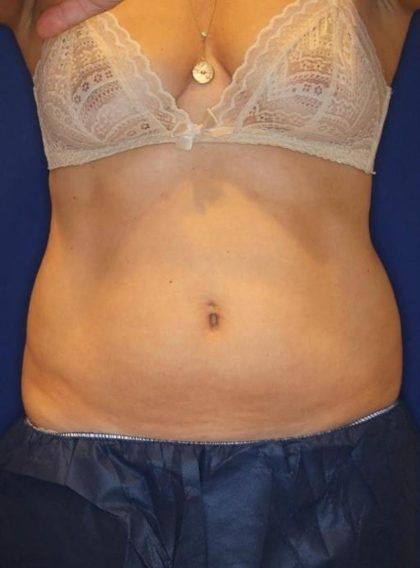 CoolSculpting Elite Before & After Patient #14219