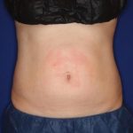 CoolSculpting Elite Before & After Patient #14219