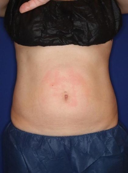 CoolSculpting Elite Before & After Patient #14219