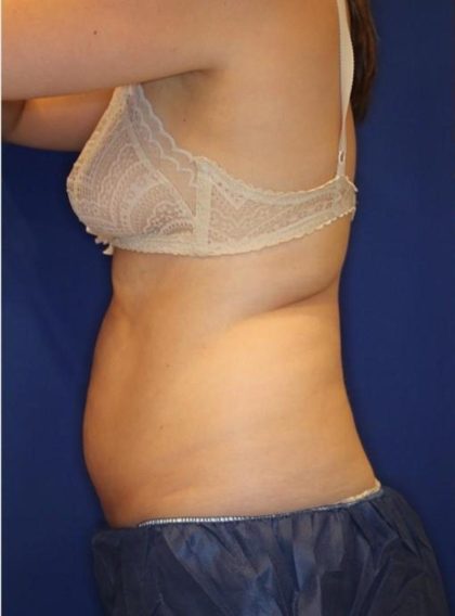 CoolSculpting Elite Before & After Patient #14219