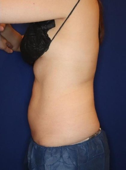 CoolSculpting Elite Before & After Patient #14219