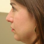 CoolSculpting Elite Before & After Patient #14220