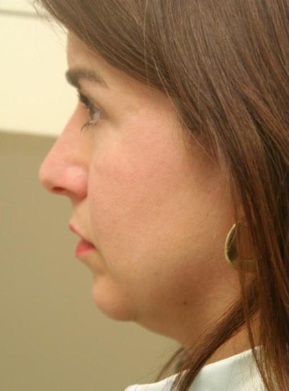 CoolSculpting Elite Before & After Patient #14220