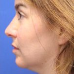 CoolSculpting Elite Before & After Patient #14220