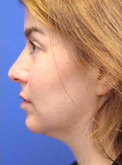CoolSculpting Elite Before & After Patient #14220