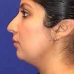CoolSculpting Elite Before & After Patient #14221