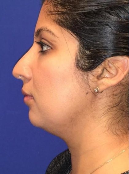 CoolSculpting Elite Before & After Patient #14221