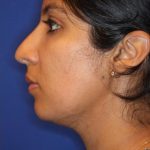 CoolSculpting Elite Before & After Patient #14221