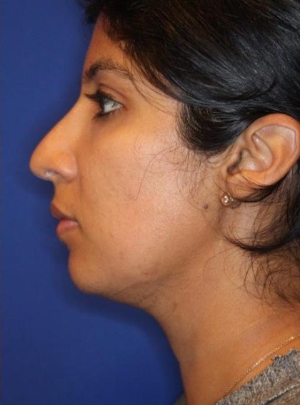 CoolSculpting Elite Before & After Patient #14221