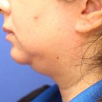 CoolSculpting Elite Before & After Patient #14203
