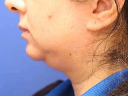 CoolSculpting Elite Before & After Patient #14203