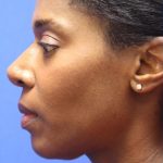 CoolSculpting Elite Before & After Patient #14222