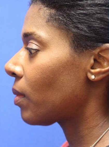 CoolSculpting Elite Before & After Patient #14222