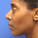 CoolSculpting Elite Before & After Patient #14222