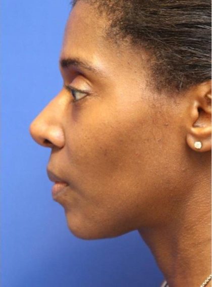 CoolSculpting Elite Before & After Patient #14222