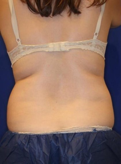 CoolSculpting Elite Before & After Patient #14219