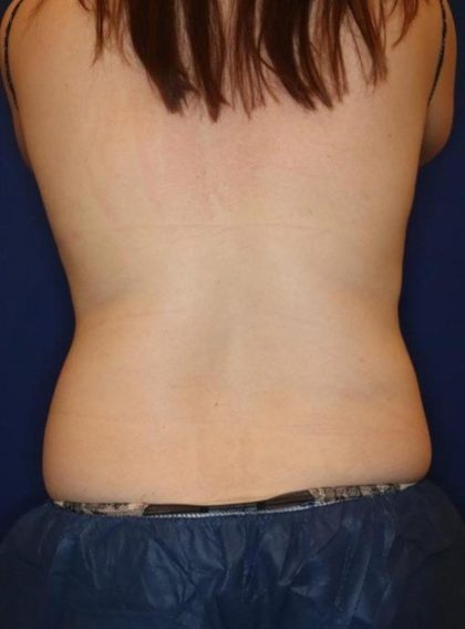CoolSculpting Elite Before & After Patient #14219