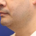 CoolSculpting Elite Before & After Patient #14204