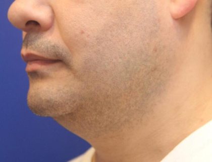 CoolSculpting Elite Before & After Patient #14204