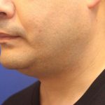 CoolSculpting Elite Before & After Patient #14204