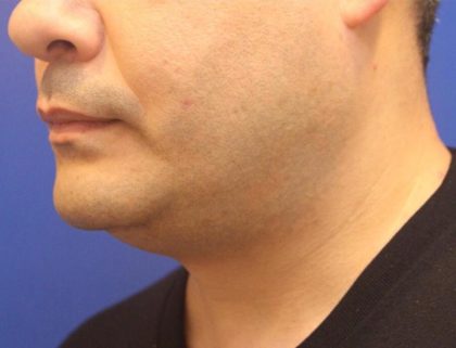 CoolSculpting Elite Before & After Patient #14204