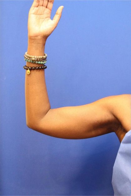 CoolSculpting Elite Before & After Patient #14205