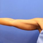 CoolSculpting Elite Before & After Patient #14205
