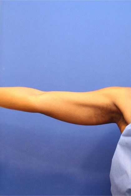 CoolSculpting Elite Before & After Patient #14205