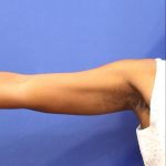 CoolSculpting Elite Before & After Patient #14205