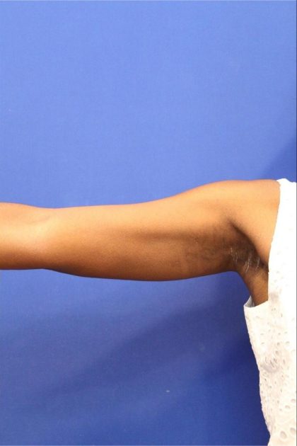 CoolSculpting Elite Before & After Patient #14205