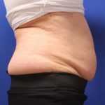 CoolSculpting Elite Before & After Patient #14206