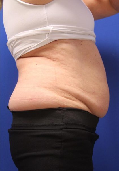 CoolSculpting Elite Before & After Patient #14206
