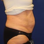 CoolSculpting Elite Before & After Patient #14206