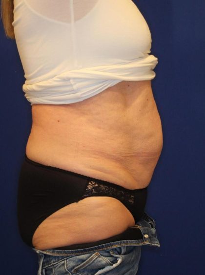 CoolSculpting Elite Before & After Patient #14206