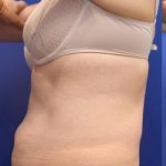CoolSculpting Elite Before & After Patient #14208