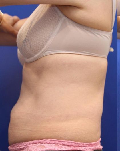 CoolSculpting Elite Before & After Patient #14208